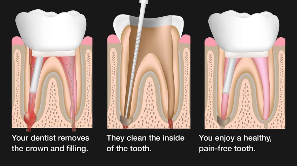 Root Canal Treatment – Manik Dental Clinic