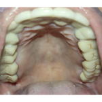 15.FINAL PROSTHESIS