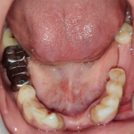 5.EXTRACTION OF ANTERIOR TEETH