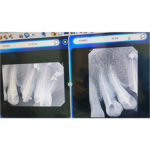 6. ROOT CANAL TREATMENT