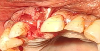 4.BONE GRAFT AND MEMBRANE PLACED