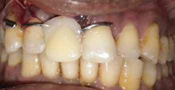 6. PROVISIONAL PROSTHESIS  GIVEN