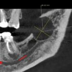 1b. PREOPERATIVE MRI