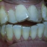 5.ALIGNERS GIVEN