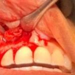 3. IMPACTED TEETH EXPOSED