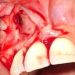 4. IMPACTED TEETH EXTRACTED